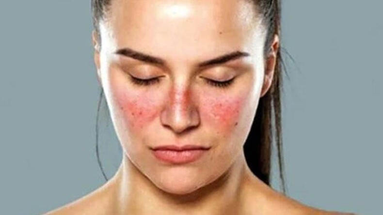 Yüzünüzdeki lekeler lupus belirtisi olabilir! Pek çok organı etkileyebiliyor